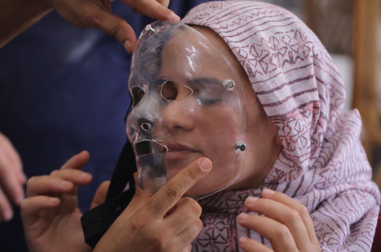 Gaza burn survivors get 3D face masks closer to home